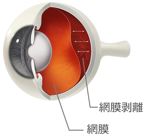 網膜剥離の図